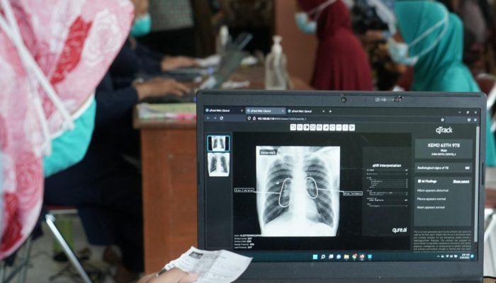 Kenali Kelompok yang Berisiko Tinggi Tertular TBC
